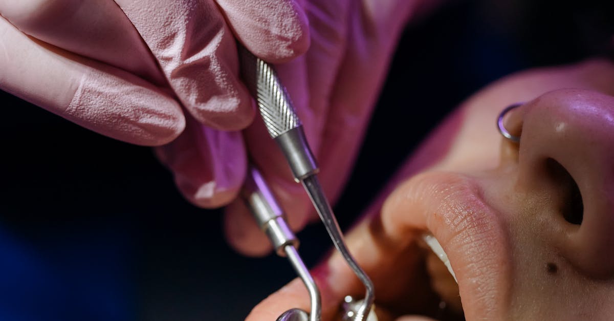 Overview of Cavities: Prevention and Treatment Options
